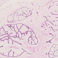 葉状腫瘍